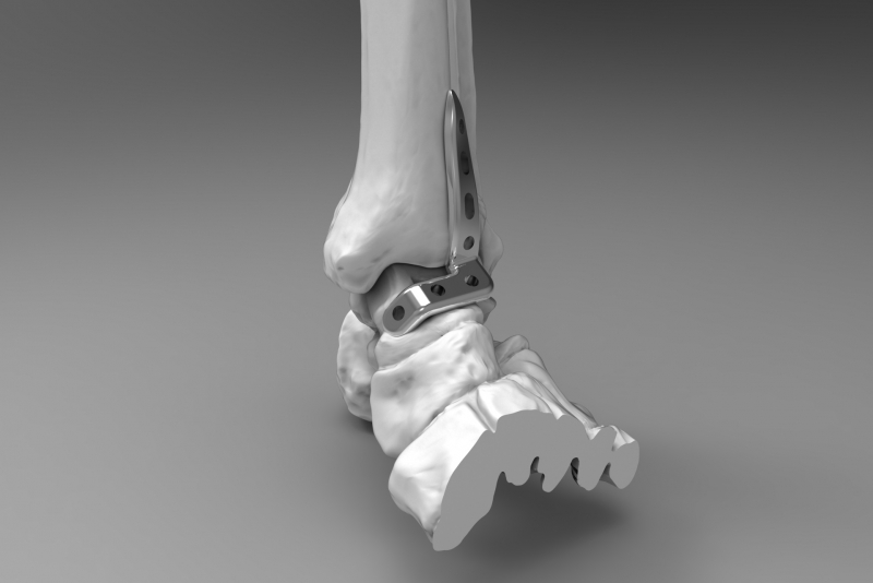 Ankle plate 3 Medical